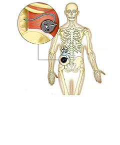 Implantabilní infúzní pumpy