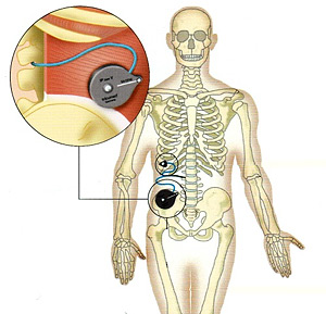 Implantabilní infúzní pumpy