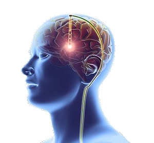 Nový systém pro hlubokou mozkovou stimulaci Infinity™