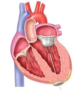 TMVI chlopeň Tendyne