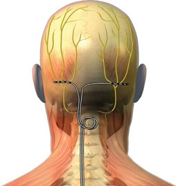 Neuromodulace v léčbě migrény